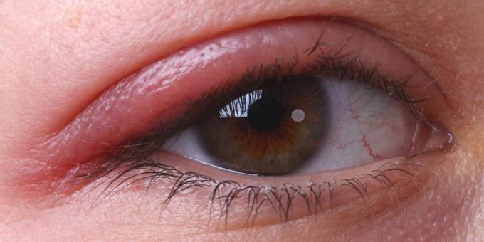 De ce senzația de mâncărime ochii: blefarită