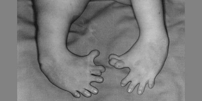 Deformitatea picioarelor unui nou-născut a cărui mamă a luat talidomidă. Efectele secundare ale medicamentului sunt numite un exemplu al acțiunilor Big Pharma.
