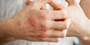 Ce este eczema, de ce apare și cum să o tratezi