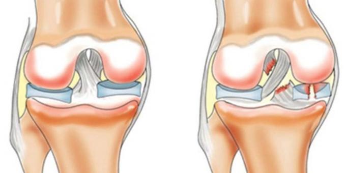 De ce doare genunchi: ruptura ligamentului incrucisat anterior