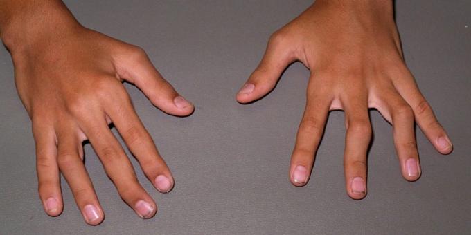 In stadiile avansate ale artritei reumatoide sunt posibile deformări și îndoire a îmbinărilor