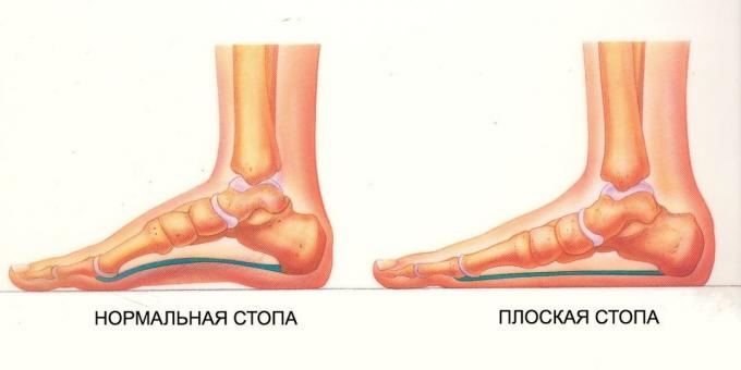exerciții pentru picioare plate: picior normal și plat
