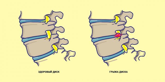coloanei vertebrale Hernia comparativ cu un spate sănătos