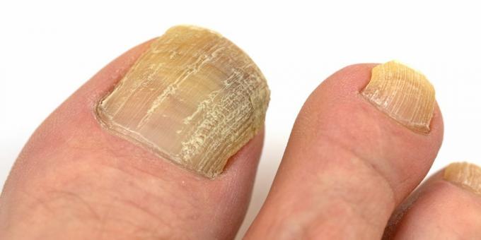Dermatomicoza: ciuperca unghiilor