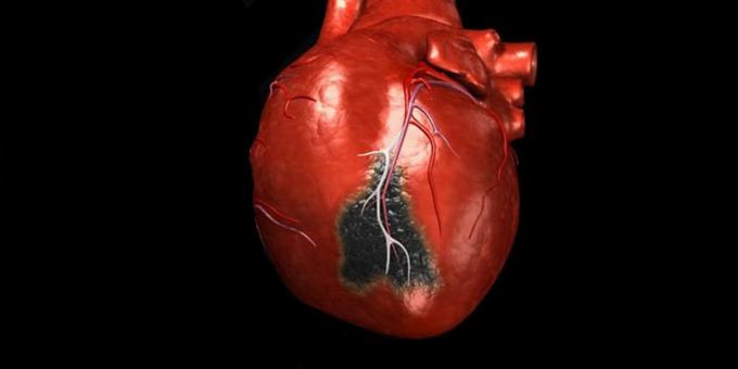 Simptomele unui atac de cord, pentru care aveți nevoie pentru a apela o ambulanță