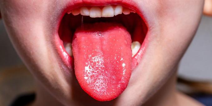 Simptome ale febrei stacojii: Limbă de căpșuni