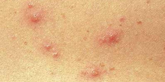 Simptomele de varicela la copii și adulți: Destul de des, pielea apar imediat puncte mici rosii